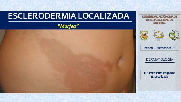esclerodermia localizada morfea